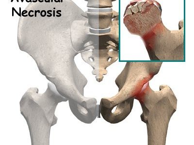 Avascular Necrosis Of The Hip