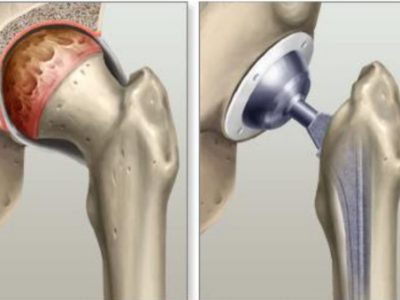 Direct Anterior Total Hip Replacement