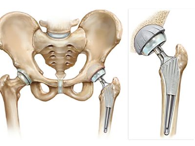 Total Hip Replacement