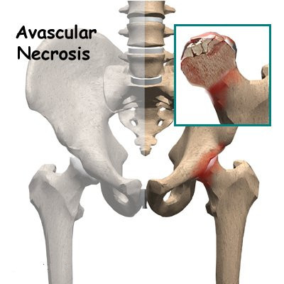 Avascular Necrosis Of The Hip