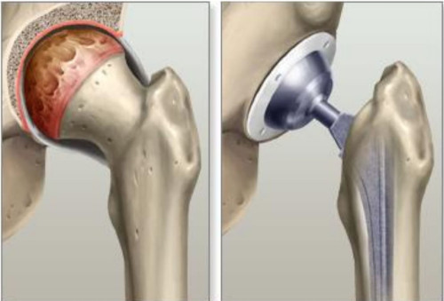 Direct Anterior Total Hip Replacement